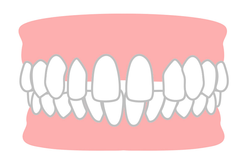 空隙歯列（くうげきしれつ）